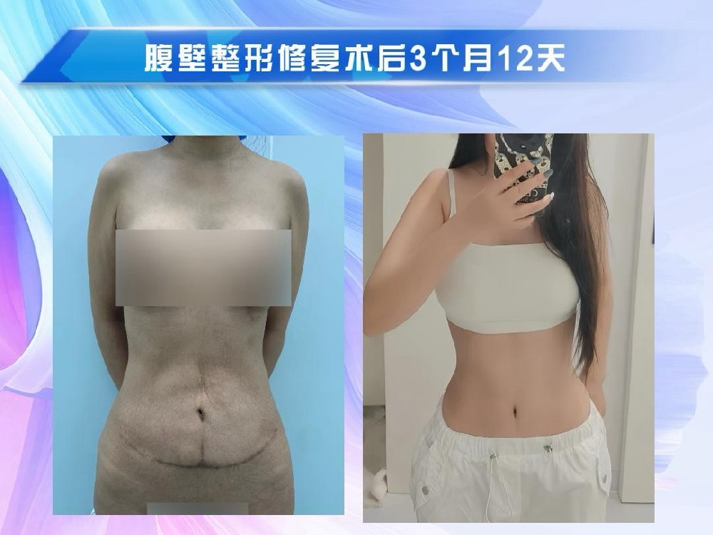 腹壁整形修复术后3个月12天