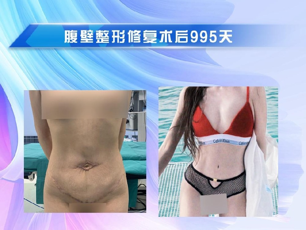 腹壁整形修复术后955天