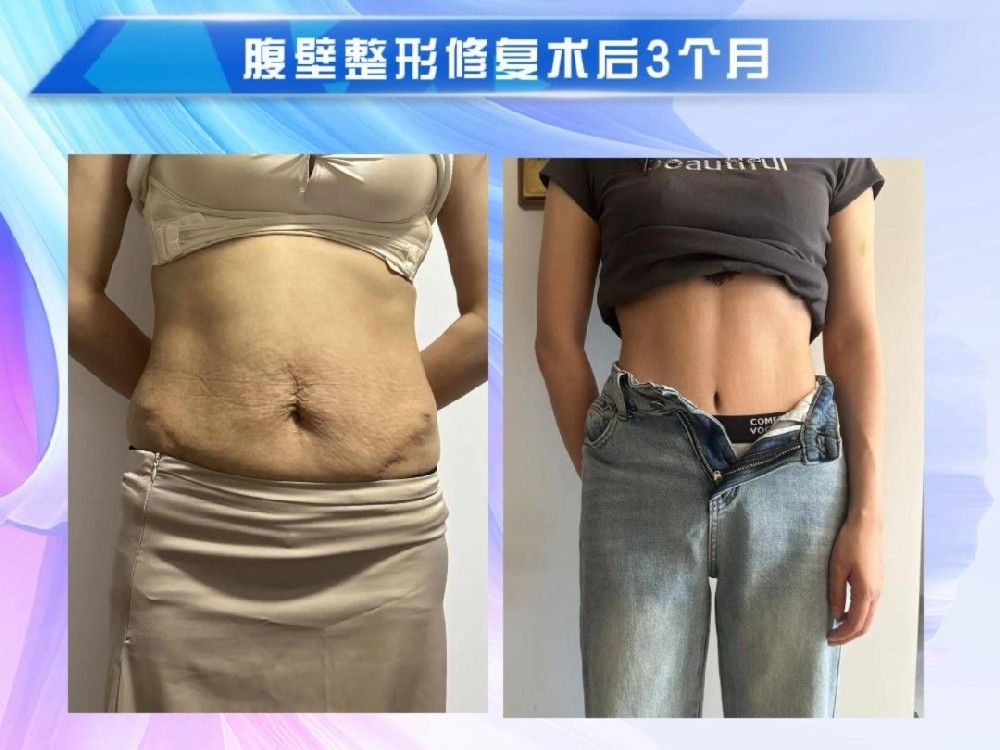 腹壁整形修复术后3个月