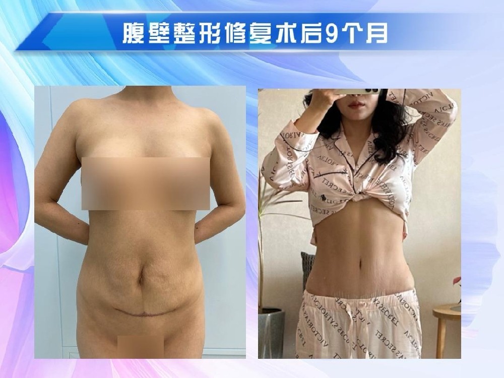 腹壁整形修复术后9个月