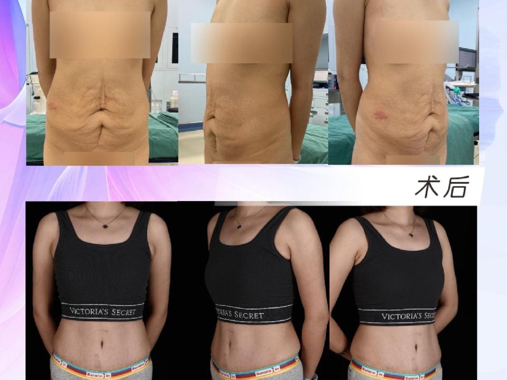 腹壁整形术后7个月16天