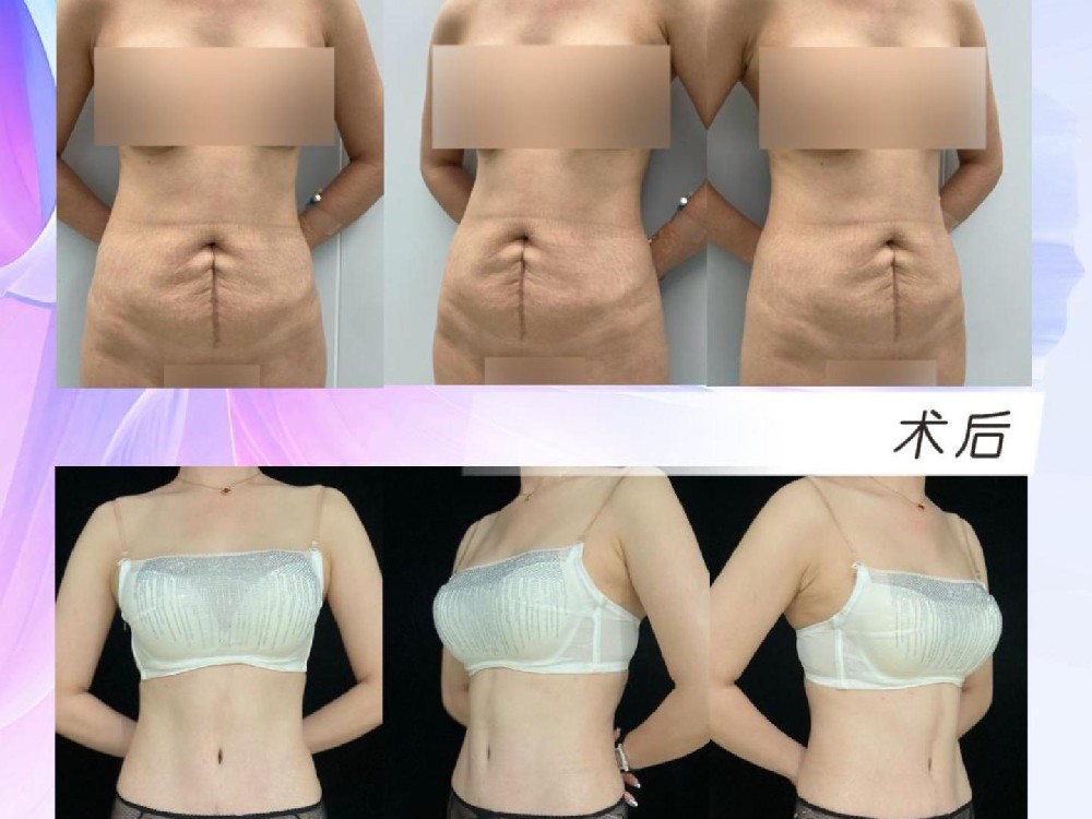 腹壁整形术后7个月8天