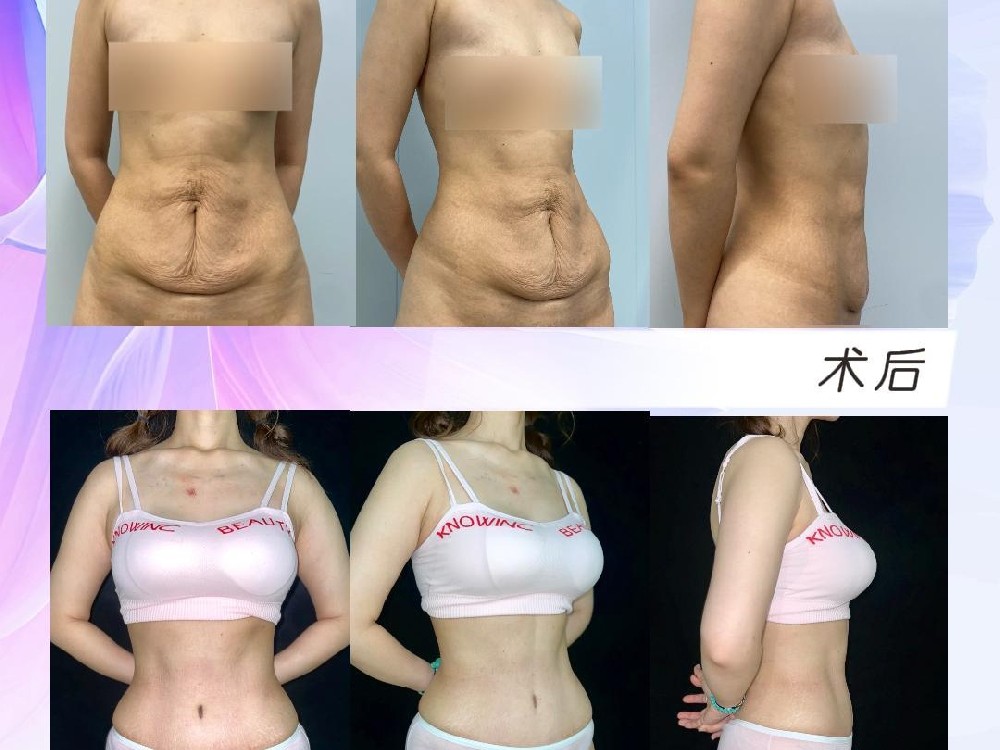 腹壁整形+胸部提升+假体隆胸（曼托至尊）术后3个月13天