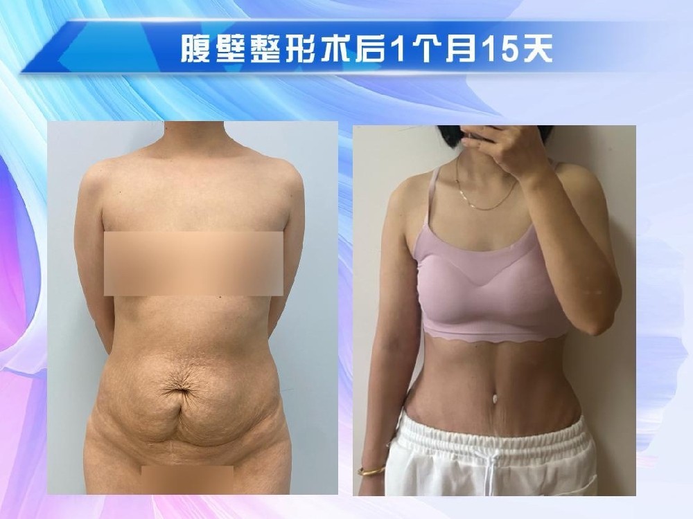 腹壁整形术后1个月15天