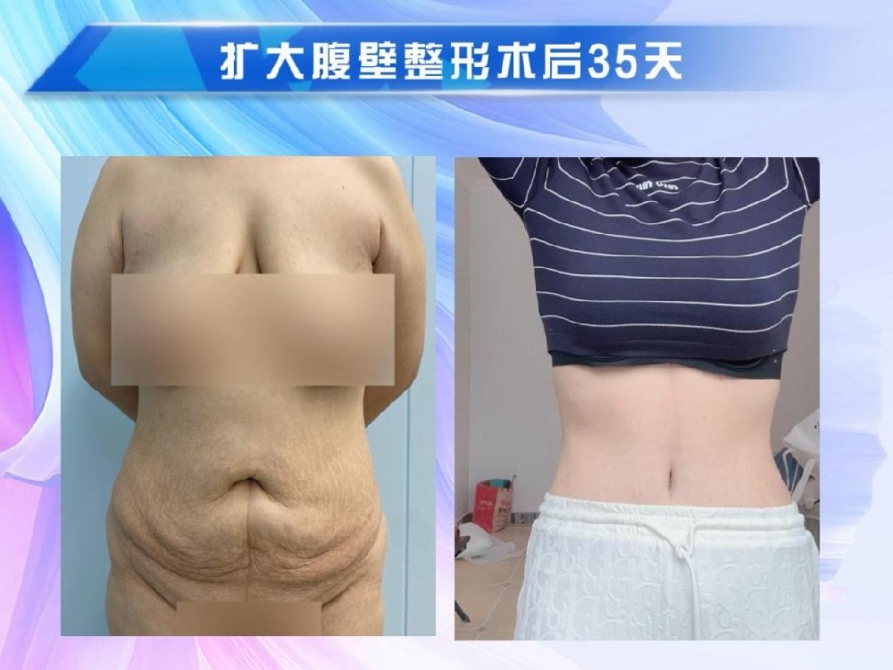 扩大腹壁整形术后35天