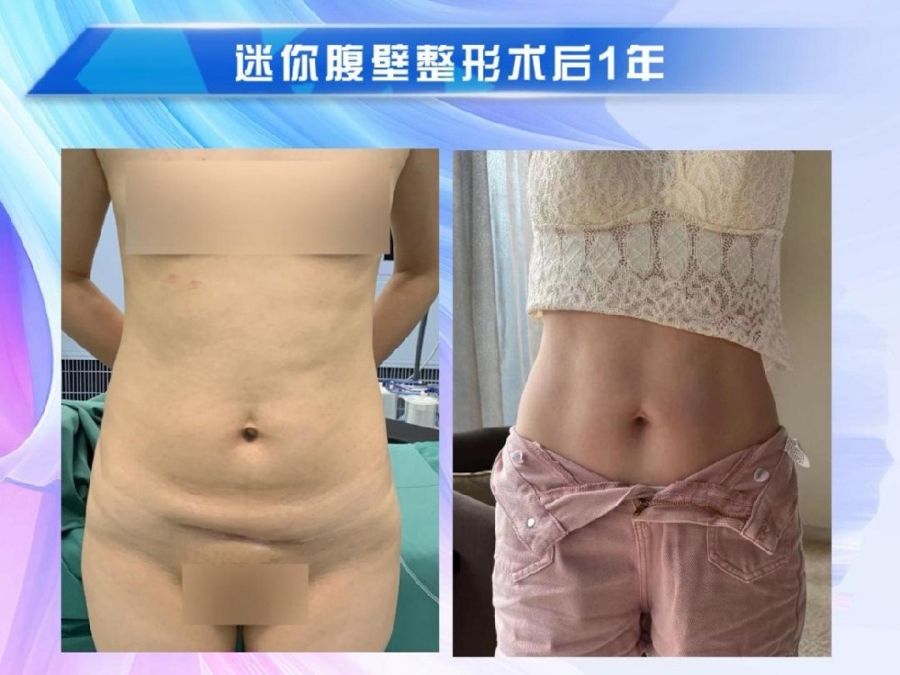 迷你腹壁整形术后1年