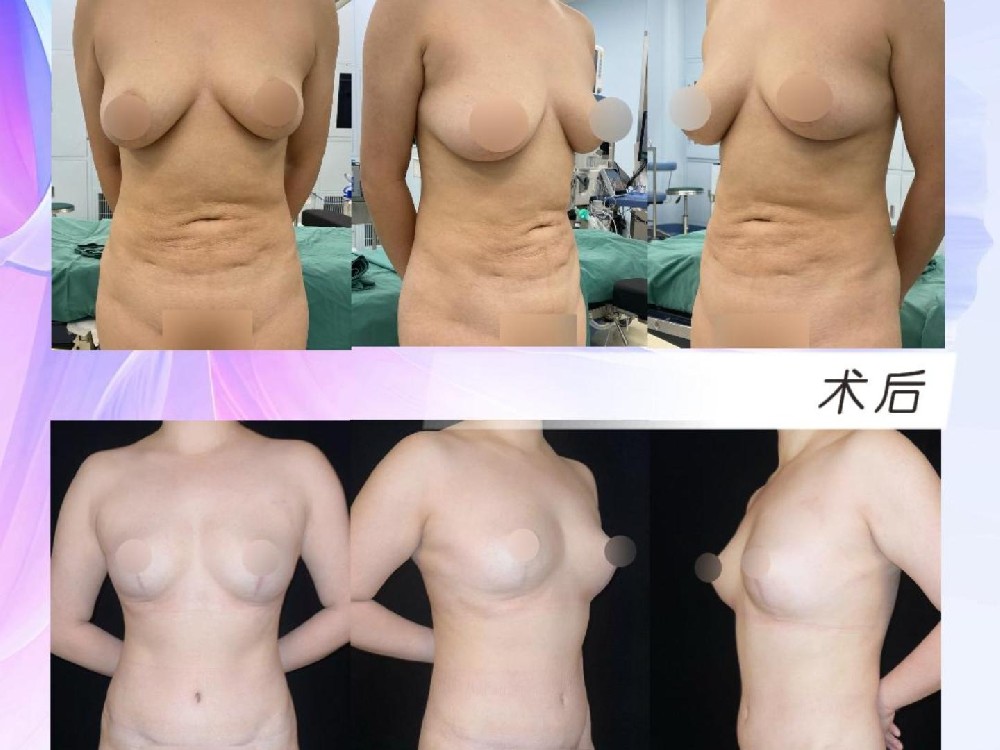 腹壁整形联合胸部提升术后19个月
