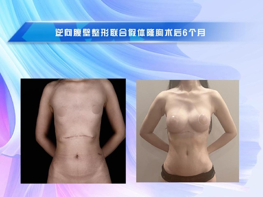逆向腹壁整形联合假体隆胸术后6个月