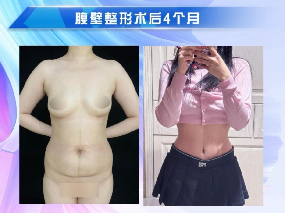 腹壁整形术后6个月