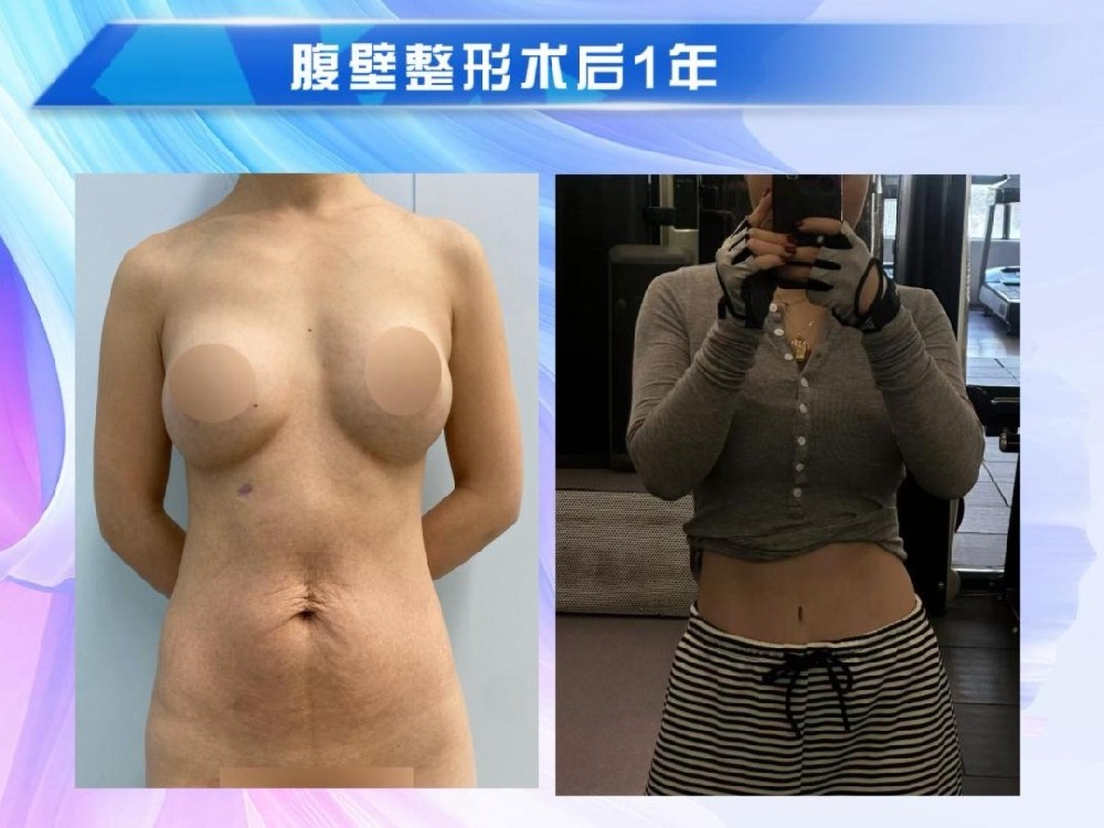 腹壁整形术后1年