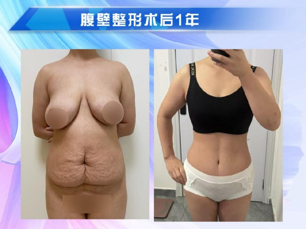 腹壁整形术后1年