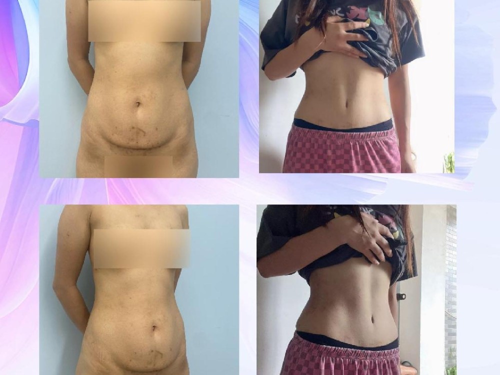 腹壁整形术后6个月