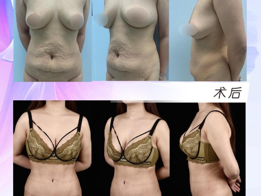 腹壁整形联合假体隆胸（ 星熠高凸）术后21个月