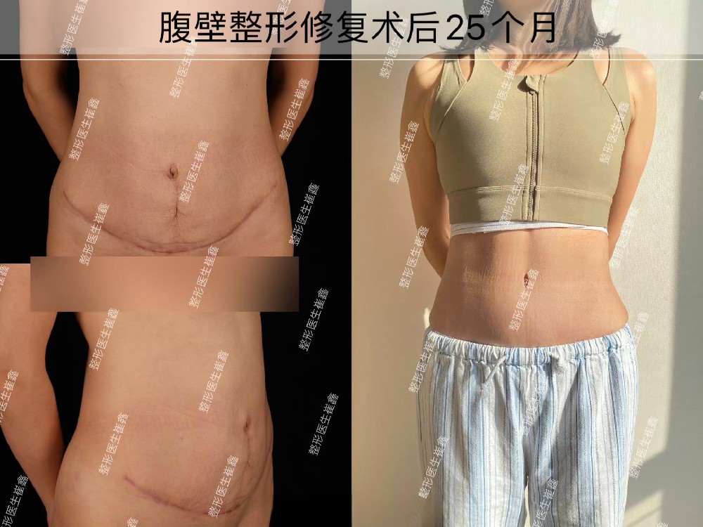 腹壁整形修复25个月