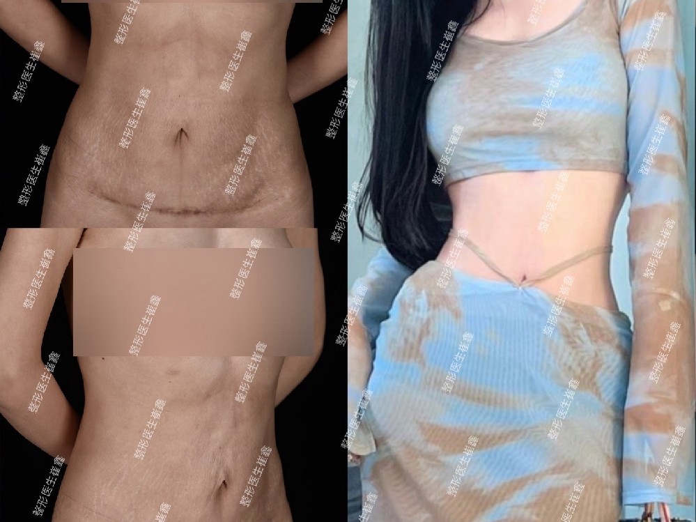 腹壁整形修复8个月