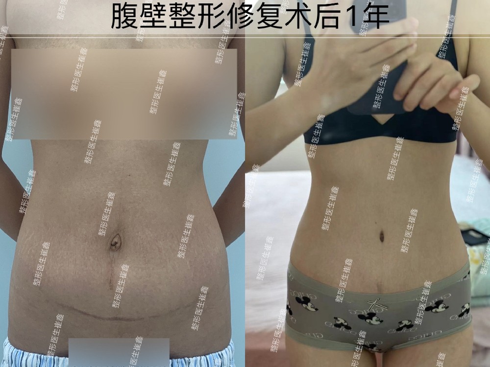 腹壁整形修复术后1年