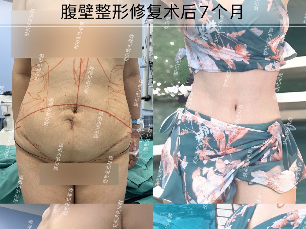 腹壁整形修复术后7个月