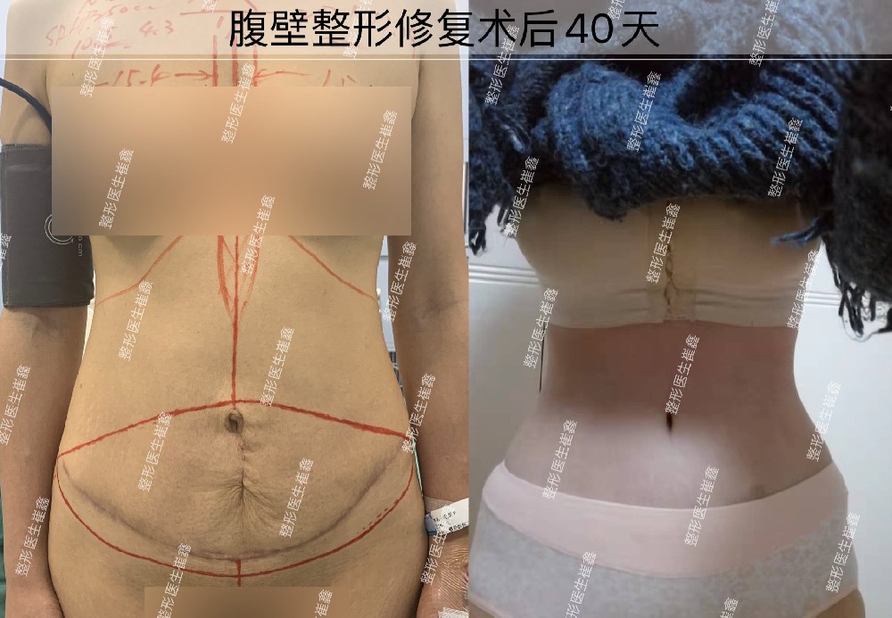 腹壁整形修复术后40天