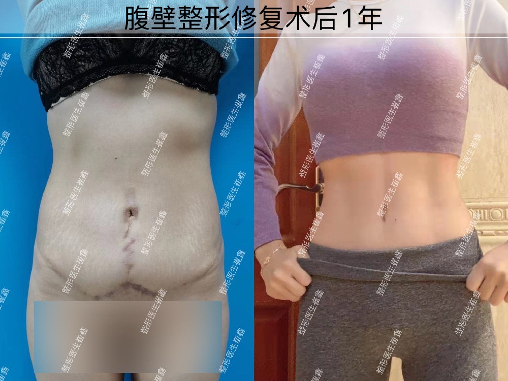 腹壁整形修复术后1年