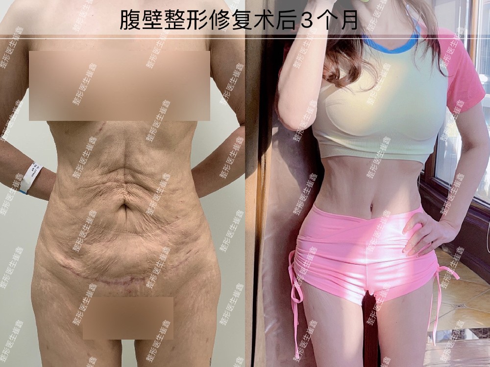 腹壁整形修复术后3个月