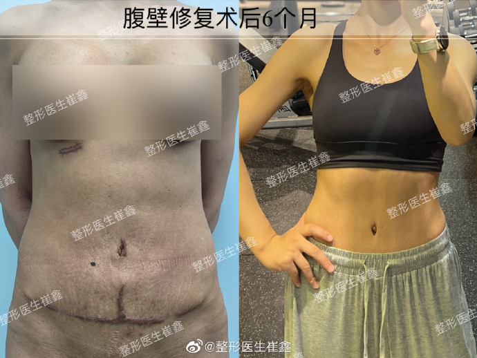 腹壁整形修复术后6个月