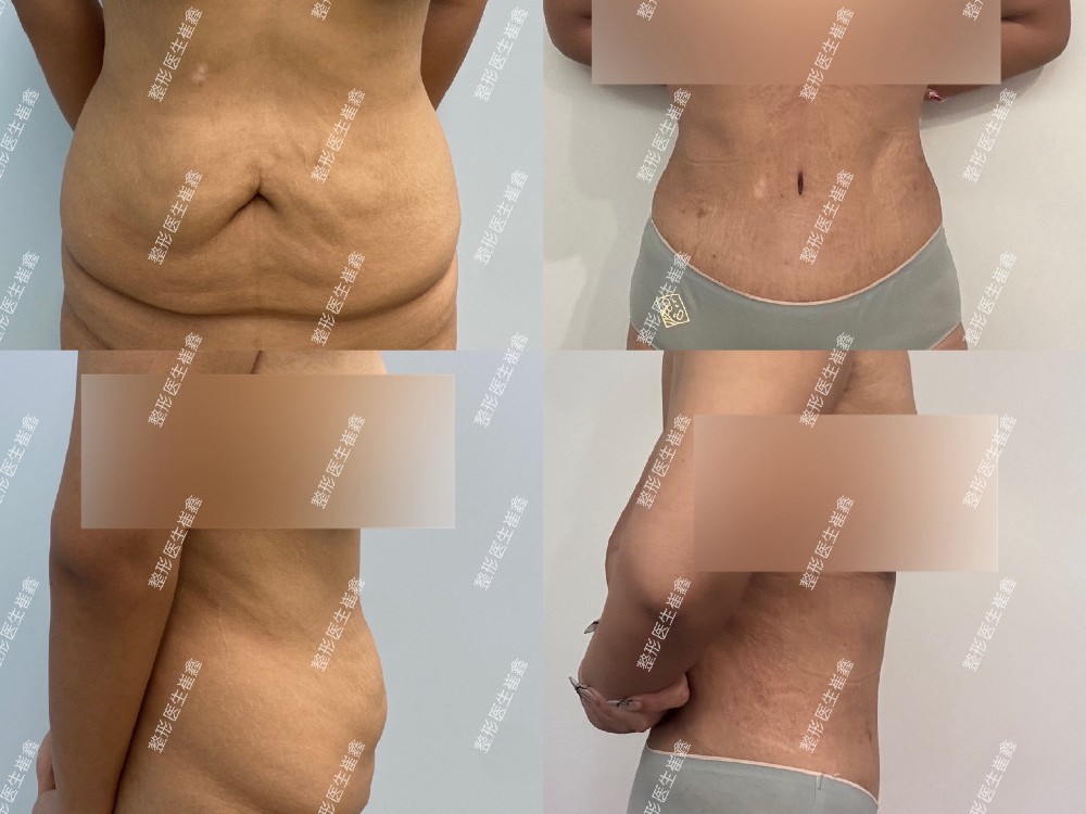 扩大腹壁整形术后3个月