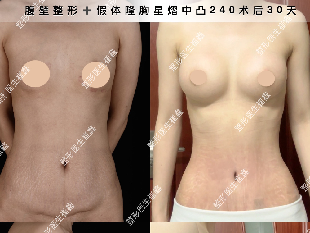 腹壁整形联合假体隆胸（星熠中凸240）术后30天
