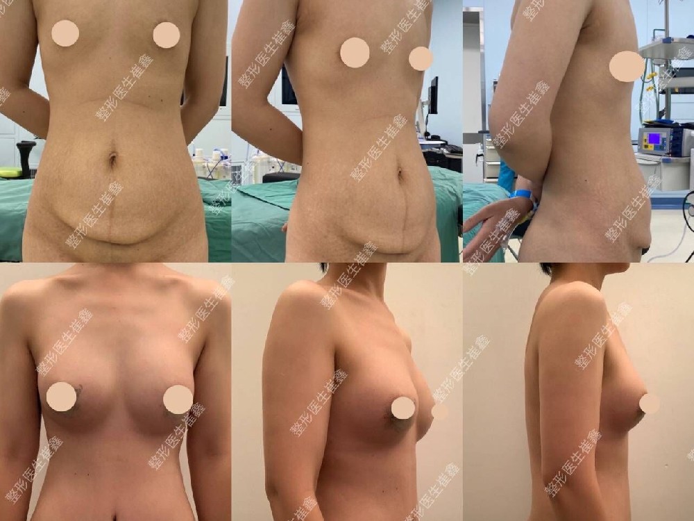 腹壁整形联合假体隆胸（曼托光圆中凸250）术后4个月