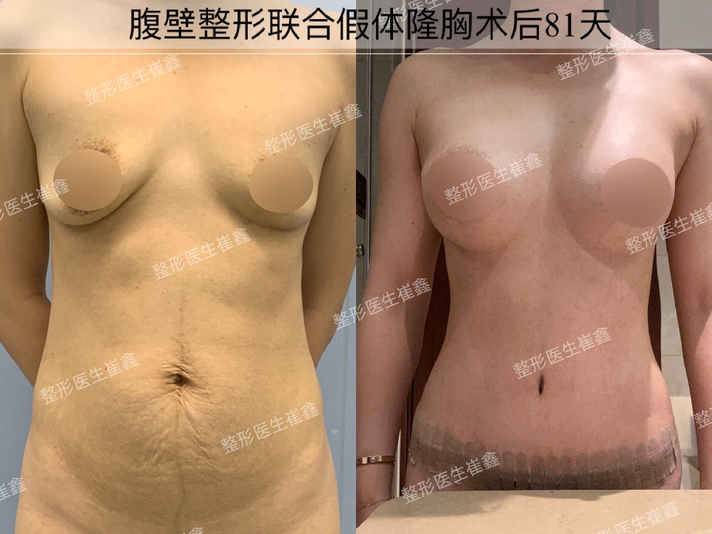 腹壁整形联合假体隆胸术后81天