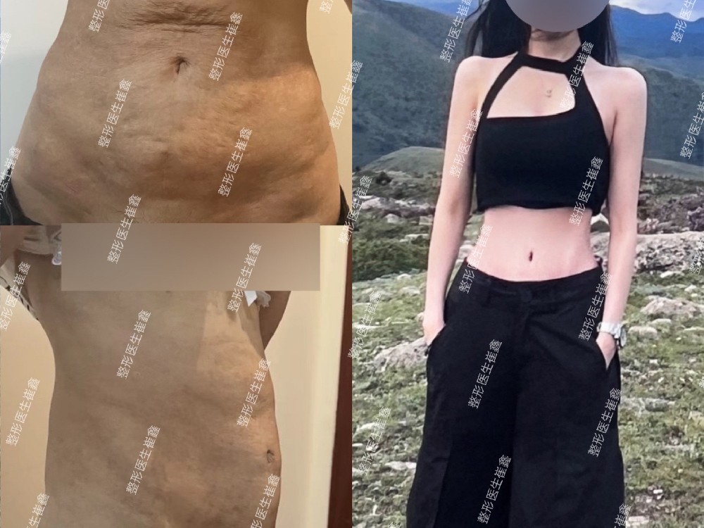 腹壁整形术后3个月