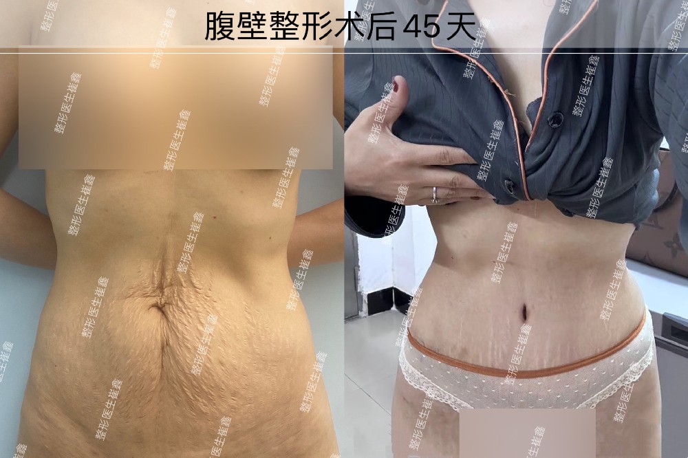 腹壁整形术后45天