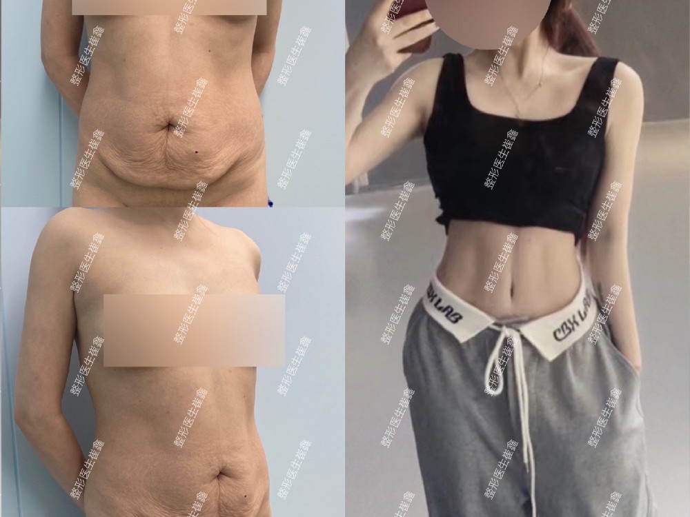 腹壁整形术后6个月