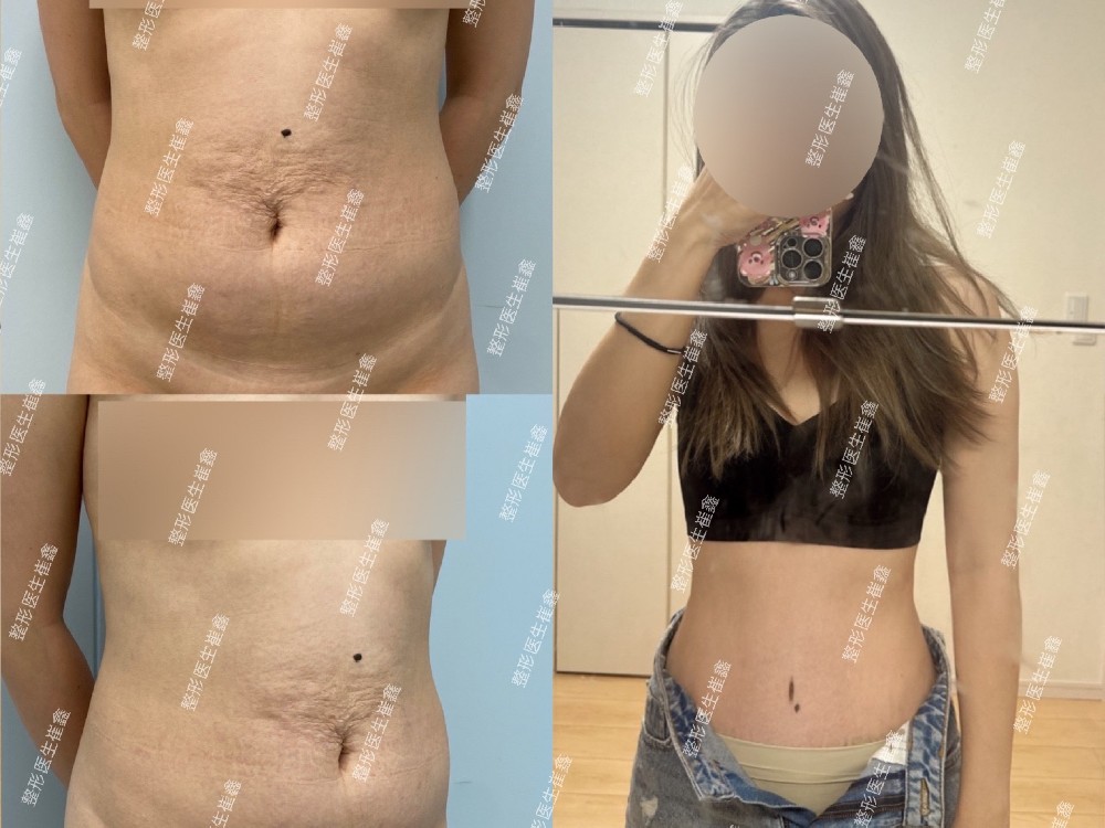 腹壁整形术后4个月