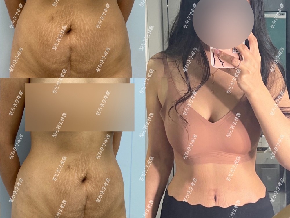 腹壁整形术后40天