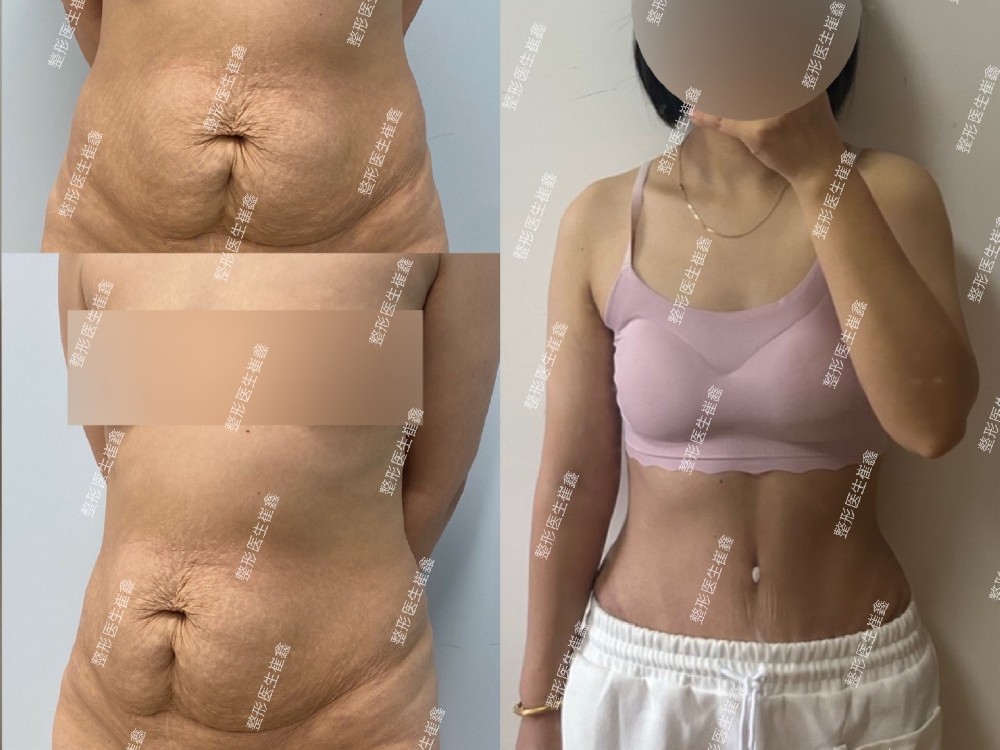 腹壁整形术后1个月15天