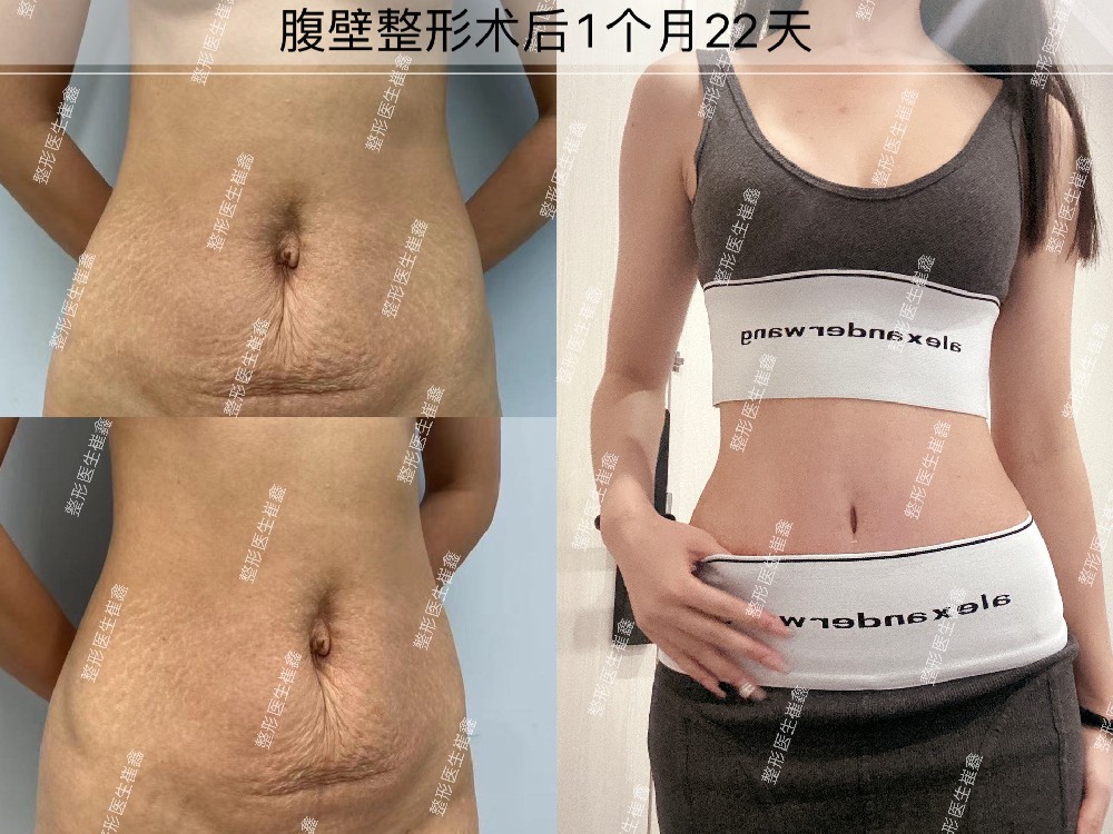腹壁整形术后1个月22天