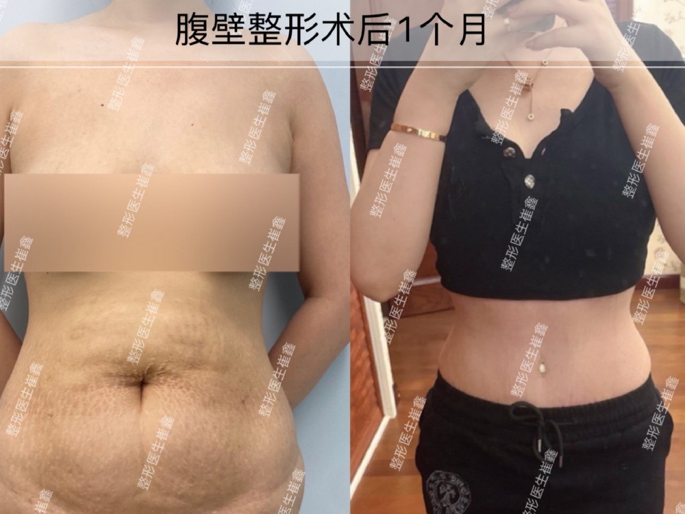 腹壁整形术后1个月