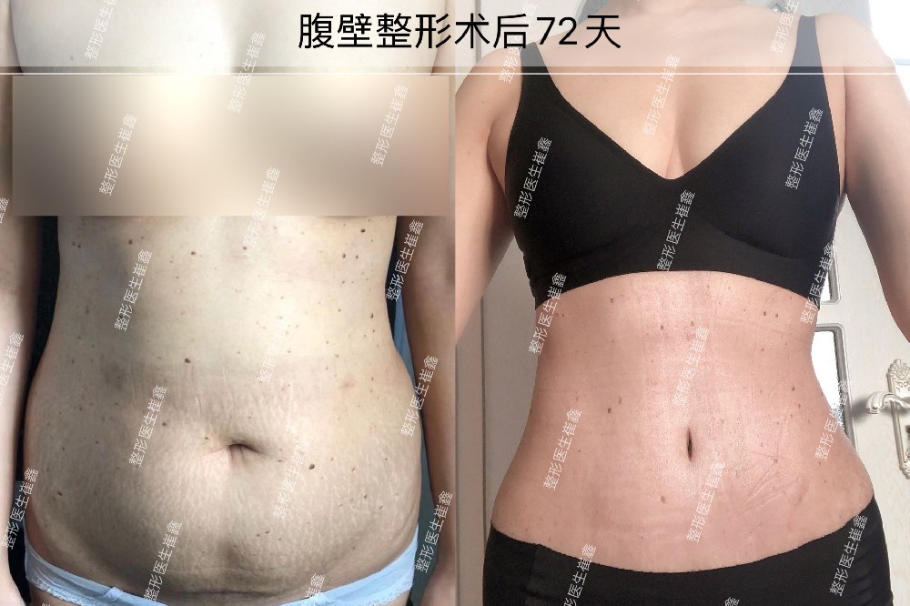 腹壁整形术后72天