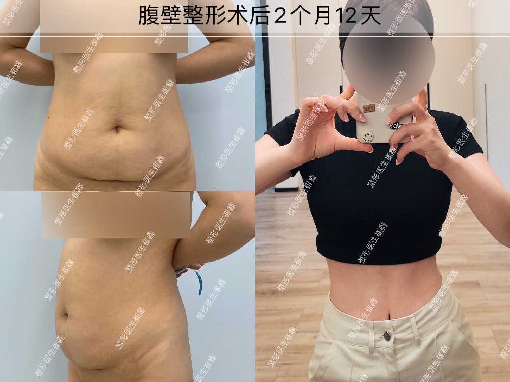 腹壁整形术后2个月12天