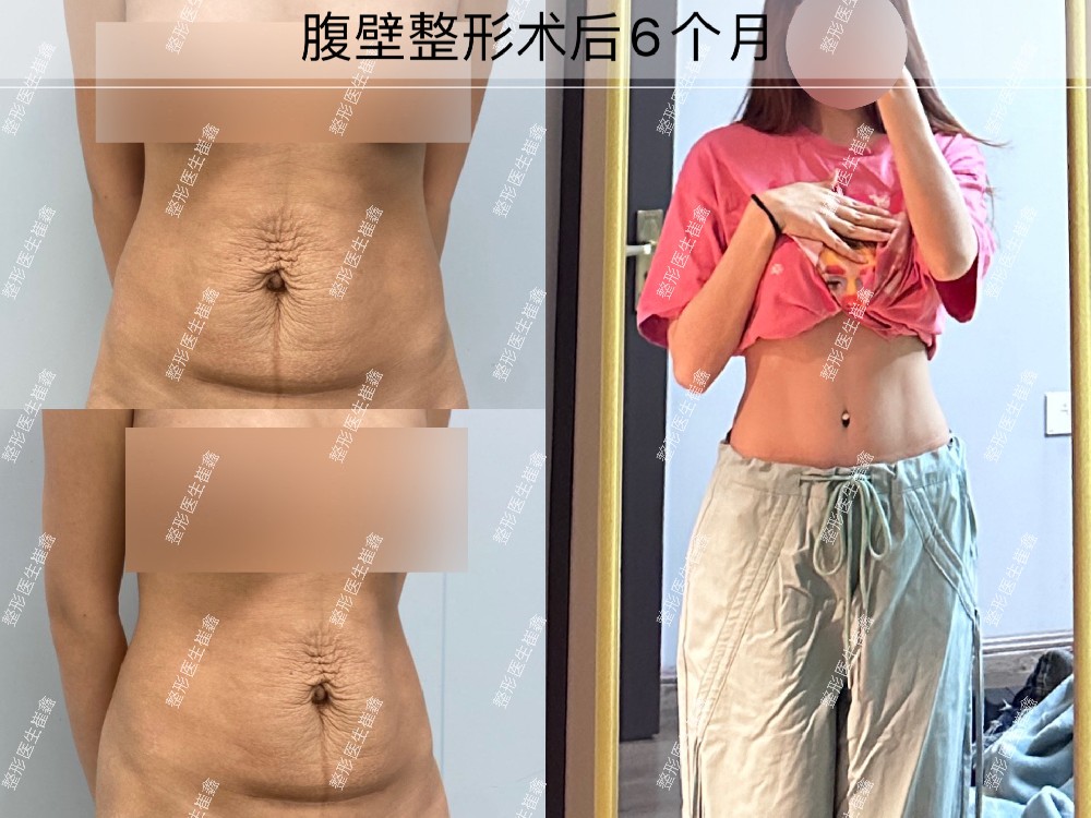 腹壁整形术后6个月