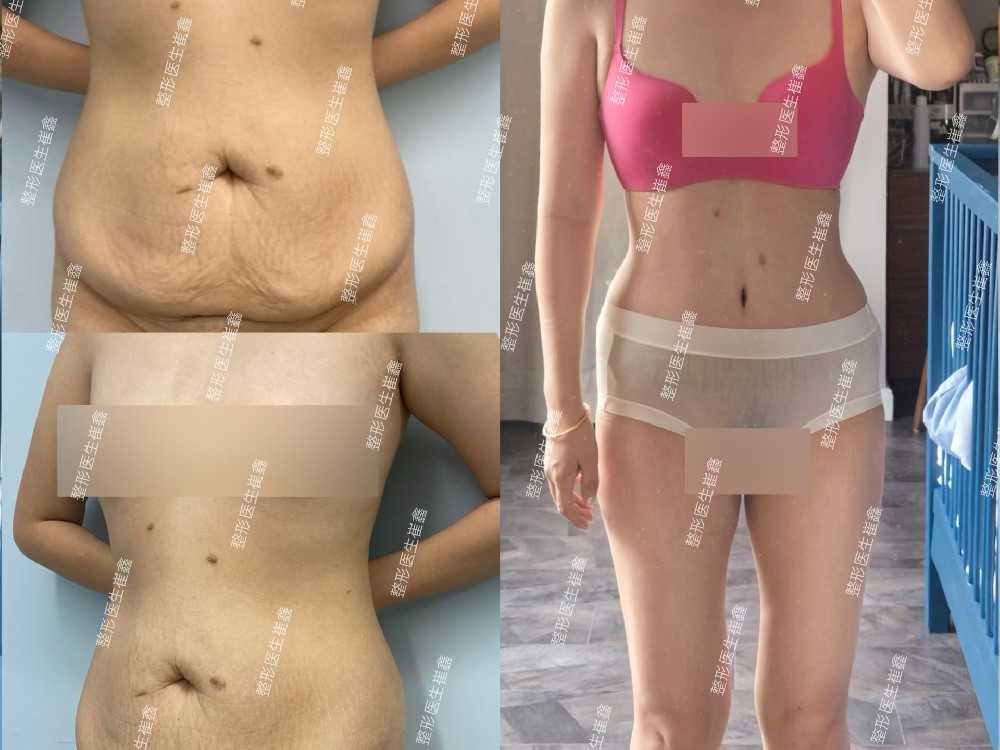 腹壁整形术后20天