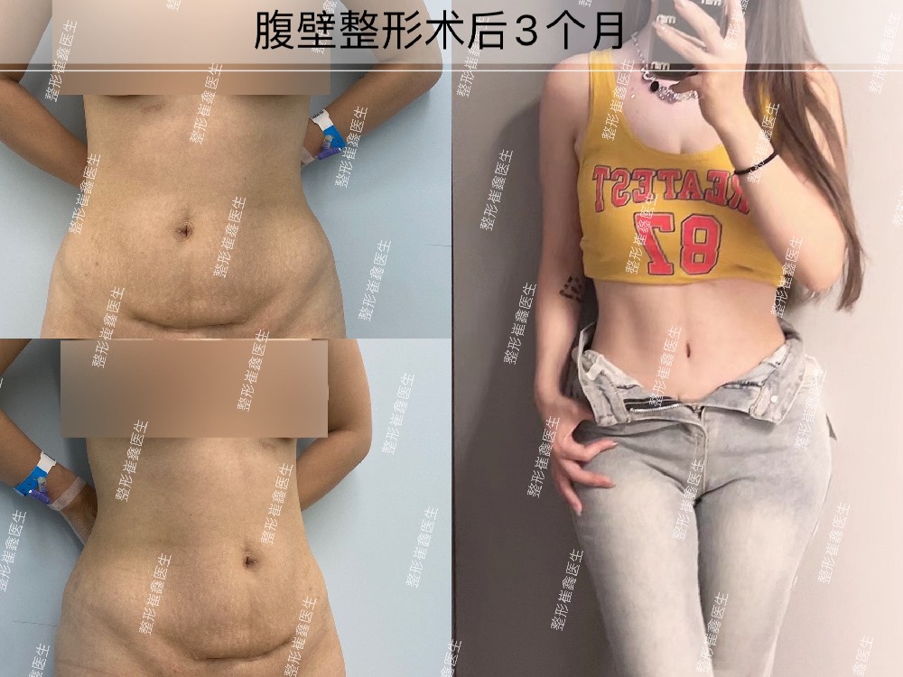 腹壁整形术后3个月