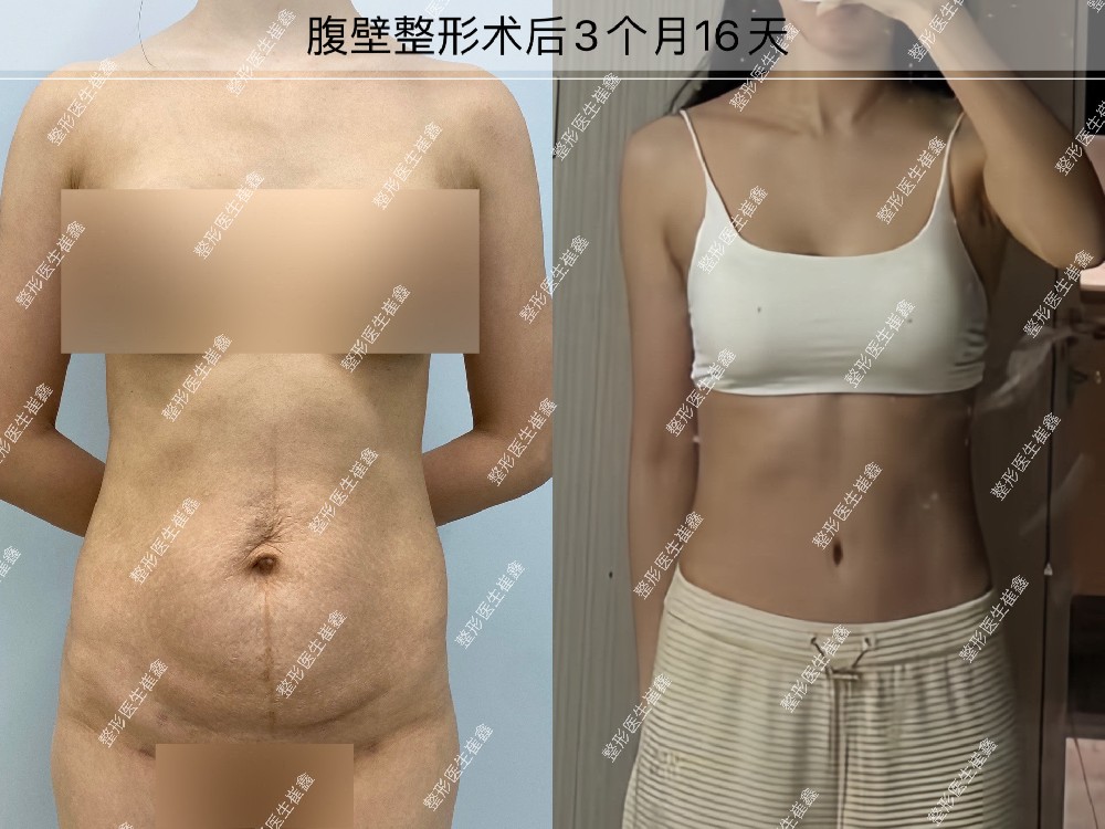 腹壁整形术后3个月16天