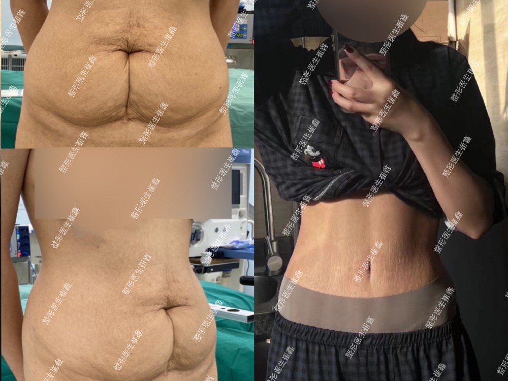 腹壁整形术后7个月20天