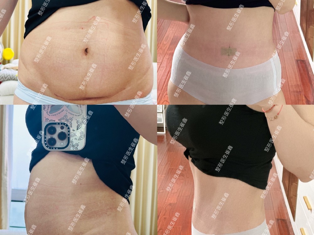 腹壁整形术后2个月24天