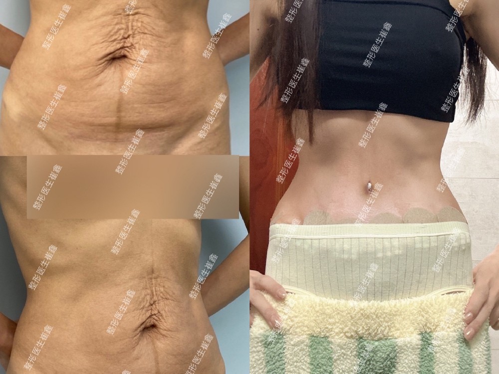 腹壁整形术后24天