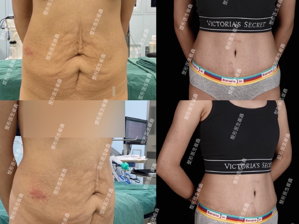 腹壁整形术后7个月16天