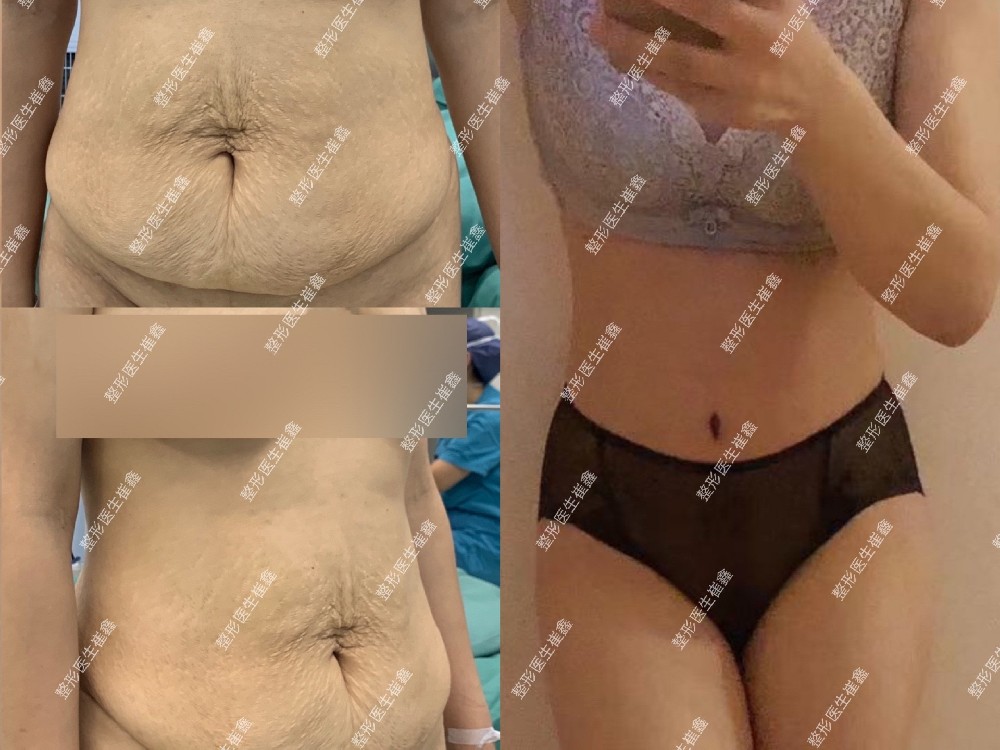 腹壁整形术后3个月