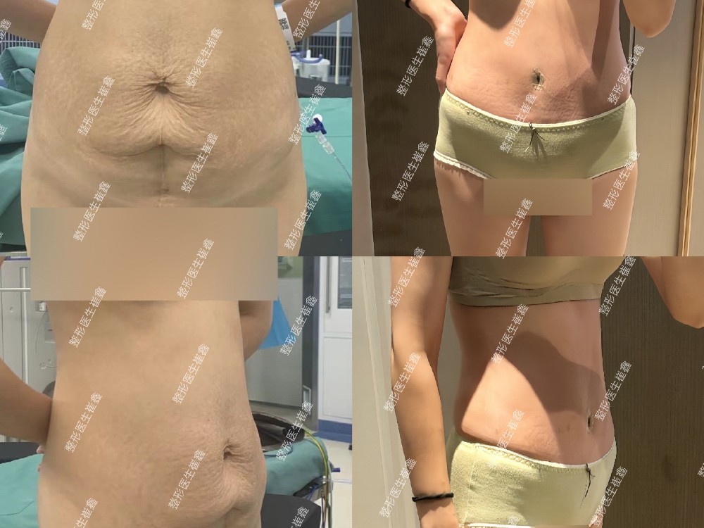 腹壁整形术后1个月