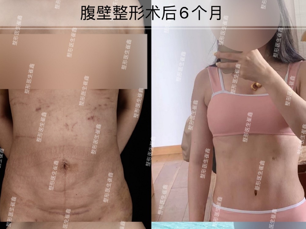腹壁整形术后6个月